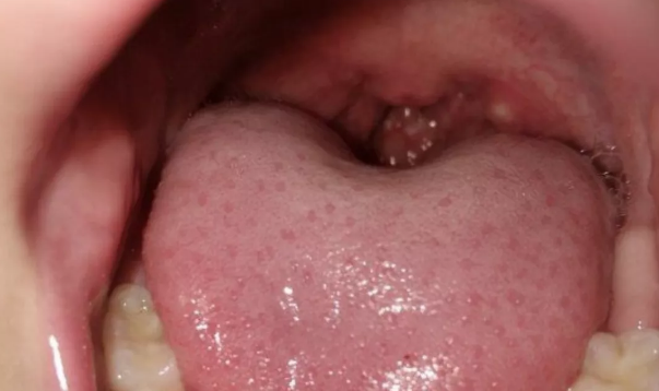 孩子皰疹性咽頰炎有什么癥狀 孩子為什么會得皰疹性咽頰炎