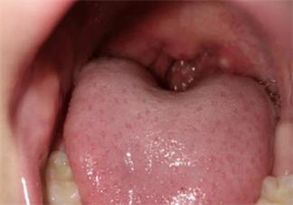 皰疹性咽頰炎怎么給孩子推拿恢復 如何調理皰疹性咽頰炎的孩子