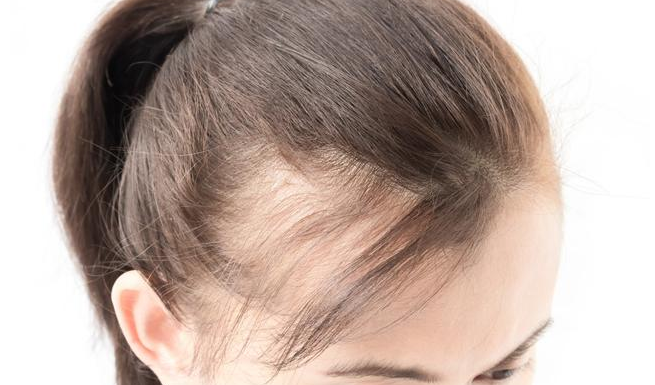 超5成大學生有脫發困擾是什么情況 90后導致脫發的六大不良習慣 超5成大學生有脫發困擾是什么情況 90后導致脫發的六大不良習慣