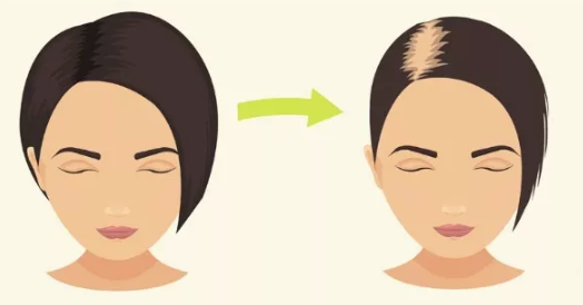 產后脫發多久能長回來 產后脫發怎么洗頭發 產后脫發多久能長回來 產后脫發怎么洗頭發