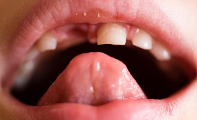 孩子幾歲會換牙 孩子換牙需要拔牙嗎