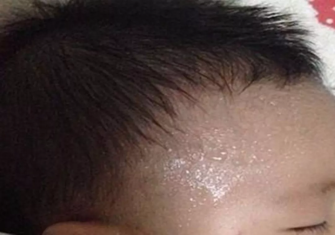 孩子為什么會長痱子 孩子的痱子有哪幾種 孩子為什么會長痱子 孩子的痱子有哪幾種