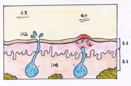 孩子為什么會長痱子 孩子的痱子有哪幾種 孩子為什么會長痱子 孩子的痱子有哪幾種