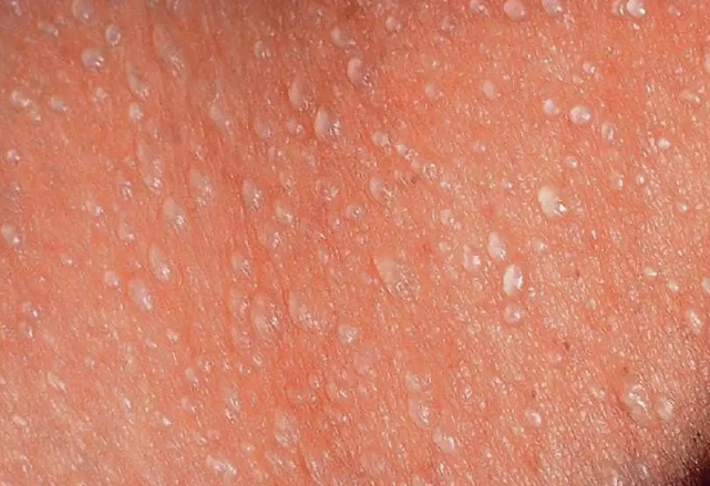 孩子為什么會長痱子 孩子的痱子有哪幾種 孩子為什么會長痱子 孩子的痱子有哪幾種