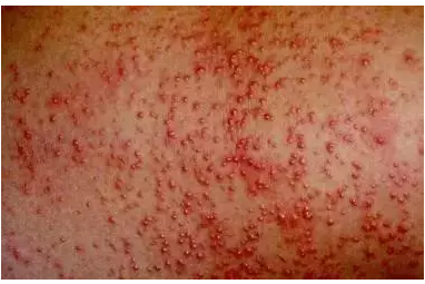 孩子為什么會長痱子 孩子的痱子有哪幾種 孩子為什么會長痱子 孩子的痱子有哪幾種