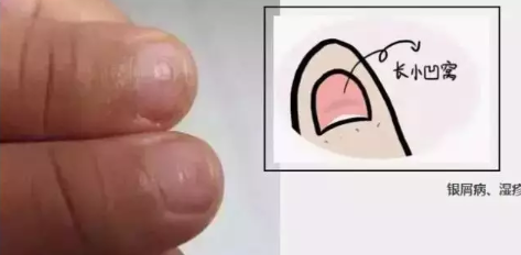 寶寶指甲長小凹窩是怎么回事 寶寶指甲長小凹窩怎么解決