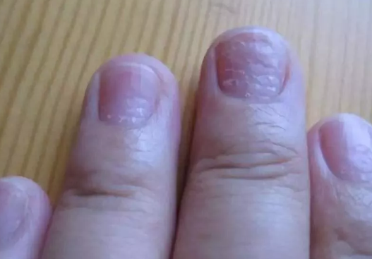 寶寶指甲長小凹窩是怎么回事 寶寶指甲長小凹窩怎么解決