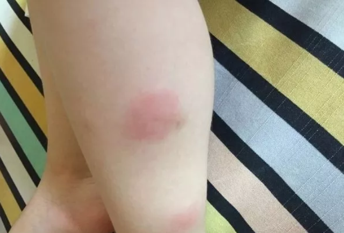 驅蚊貼和驅蚊手環真的有用嗎 正確的驅蚊方法