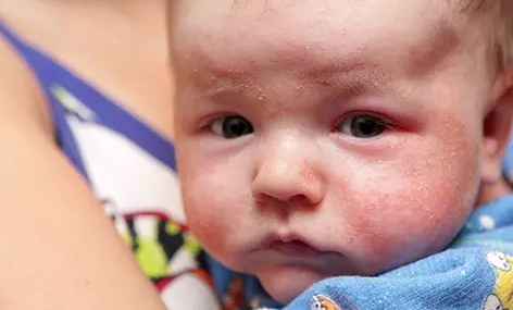 孩子的濕疹為什么會越來越多 嬰兒濕疹護理有哪些誤區