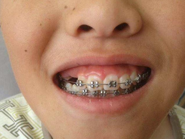 孕婦能做牙齒矯正嗎 懷孕做矯正牙齒的壞處 孕婦能做牙齒矯正嗎 懷孕做矯正牙齒的壞處