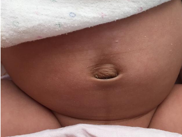 寶寶肚臍鼓包是怎么回事 寶寶臍疝護理方法 寶寶肚臍鼓包是怎么回事 寶寶臍疝護理方法