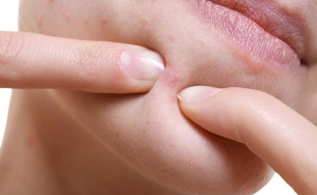 超6成大學生受青春痘困擾 長青春痘怎么調理 超6成大學生受青春痘困擾 長青春痘怎么調理