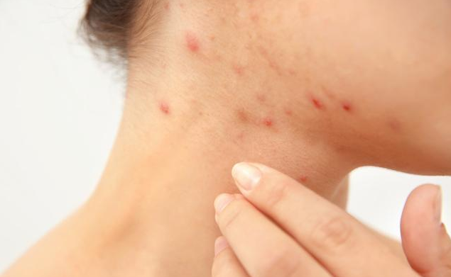 超6成大學生受青春痘困擾 長青春痘怎么調理 超6成大學生受青春痘困擾 長青春痘怎么調理