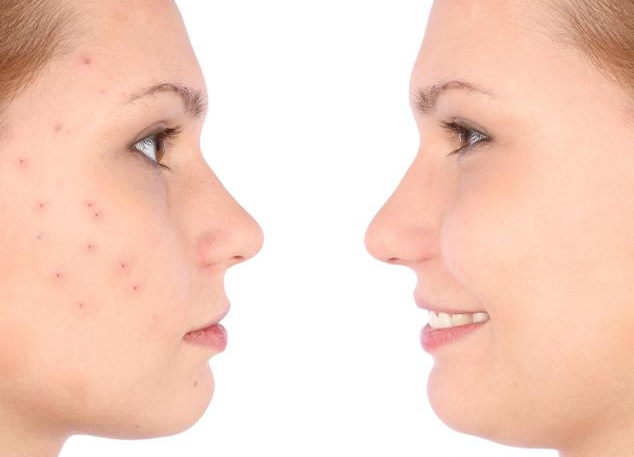 超6成大學生受青春痘困擾 長青春痘怎么調理 超6成大學生受青春痘困擾 長青春痘怎么調理