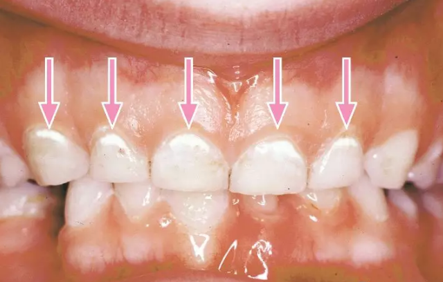 為什么要定期看牙醫(yī) 孩子的牙齒需要經(jīng)常去牙醫(yī)院檢查嗎 為什么要定期看牙醫(yī) 孩子的牙齒需要經(jīng)常去牙醫(yī)院檢查嗎