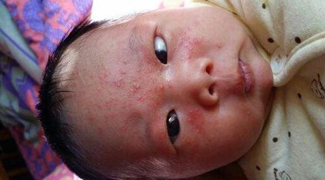 如何區分痱子和濕疹 痱子濕疹混合怎么辦 如何區分痱子和濕疹 痱子濕疹混合怎么辦