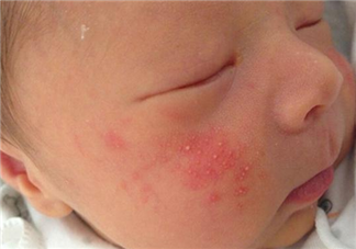 如何區(qū)分痱子和濕疹 痱子濕疹混合怎么辦