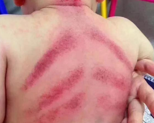 嬰兒刮痧有用嗎 能給嬰兒刮痧嗎 嬰兒刮痧有用嗎 能給嬰兒刮痧嗎