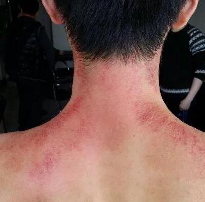 嬰兒刮痧有用嗎 能給嬰兒刮痧嗎 嬰兒刮痧有用嗎 能給嬰兒刮痧嗎