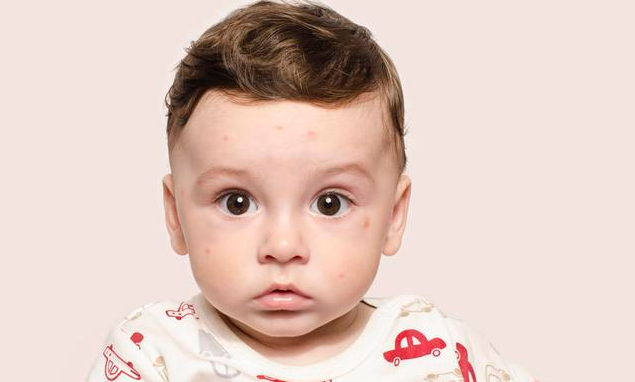 寶寶被蚊子咬了怎么止癢比較好 這些錯誤止癢方法要避免 寶寶被蚊子咬了怎么止癢比較好 這些錯誤止癢方法要避免