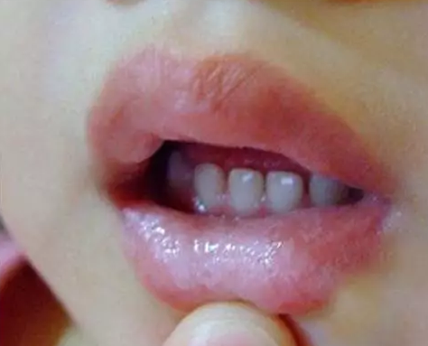 孩子鵝口瘡是什么 寶寶得了鵝口瘡怎么辦