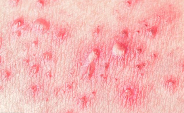 生殖器皰疹復(fù)發(fā)是怎么回事 如何預(yù)防生殖器皰疹復(fù)發(fā) 生殖器皰疹復(fù)發(fā)是怎么回事 如何預(yù)防生殖器皰疹復(fù)發(fā)