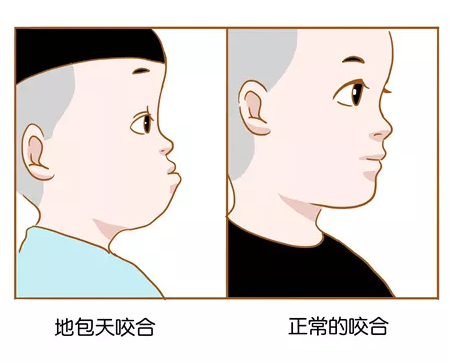 孩子牙齒地包天什么時候治療比較好 幾歲治療孩子牙齒地包天最佳 孩子牙齒地包天什么時候治療比較好 幾歲治療孩子牙齒地包天最佳