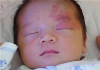 寶寶胎記需要治療嗎 胎記是怎么形成的