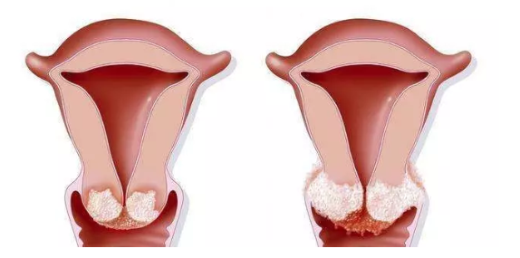 懷雙胞胎陰道出血正常嗎 預(yù)防陰道出血流產(chǎn)的正確方式 懷雙胞胎陰道出血正常嗎 預(yù)防陰道出血流產(chǎn)的正確方式