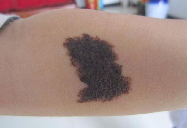 寶寶胎記需要治療嗎 胎記是怎么形成的