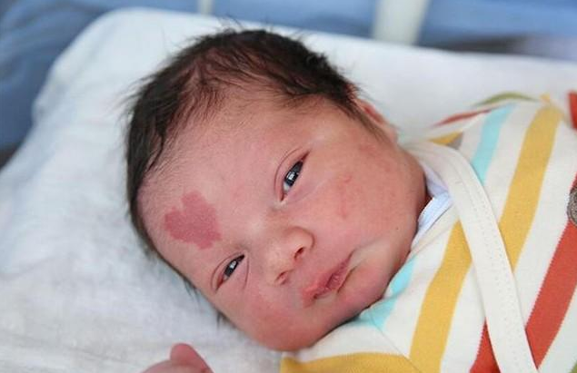 寶寶胎記需要治療嗎 胎記是怎么形成的