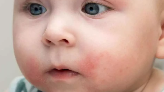 寶寶用什么去痱子比較好 寶寶為什么不能用痱子粉