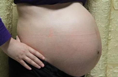 懷雙胞胎先兆子癇怎么辦 懷雙胞胎更容易先兆子癇嗎 懷雙胞胎先兆子癇怎么辦 懷雙胞胎更容易先兆子癇嗎