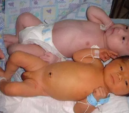 新生兒黃疸和孕婦有關(guān)系嗎 新生兒黃疸怎么辦