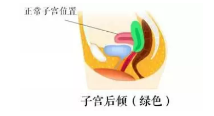 子宮后位不容易懷孕嗎 子宮后位同房怎么躺好 子宮后位不容易懷孕嗎 子宮后位同房怎么躺好
