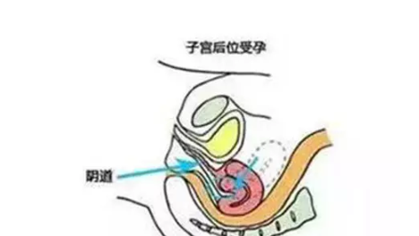 子宮后位的影響有哪些 子宮后位會導致不孕嗎