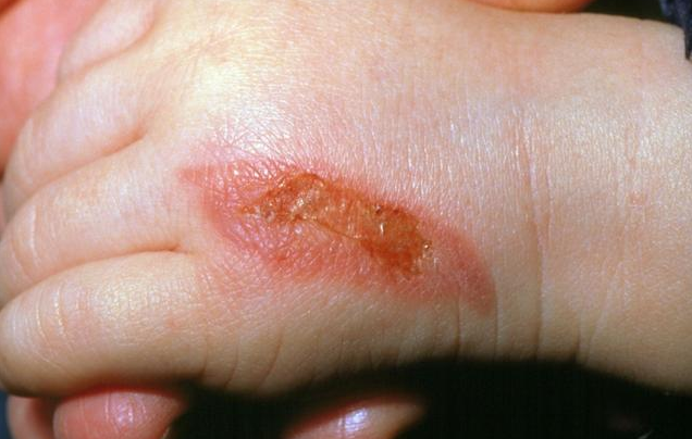 孩子燙傷抹牙膏有用嗎 孩子被燙傷處理的正確方法