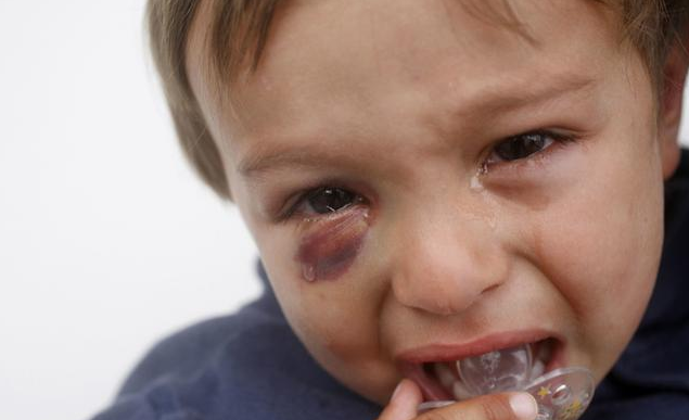 孩子燙傷抹牙膏有用嗎 孩子被燙傷處理的正確方法