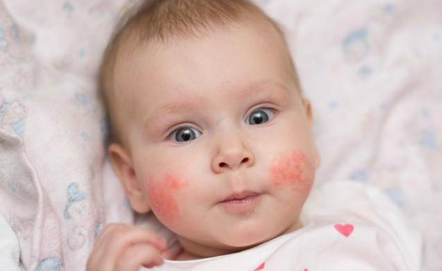 牛奶蛋白過敏的寶寶怎么喂養(yǎng) 寶寶牛奶蛋白過敏有什么表現(xiàn)