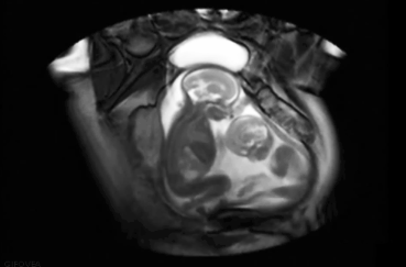 吃排卵藥真的能生雙胞胎嗎 哪種人適合吃排卵藥備孕 吃排卵藥真的能生雙胞胎嗎 哪種人適合吃排卵藥備孕