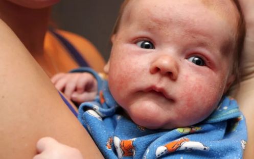 嬰兒玫瑰疹是什么 嬰兒出現玫瑰疹怎么辦