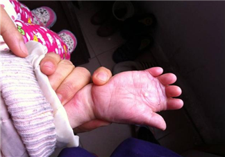 孩子燙傷抹牙膏有用嗎 孩子被燙傷處理的正確方法