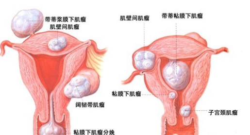 子宮肌瘤影響懷孕嗎 懷孕后發(fā)現(xiàn)子宮肌瘤有影響嗎