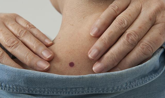 哪些部位的痣容易癌變 痣癌變有哪些信號 哪些部位的痣容易癌變 痣癌變有哪些信號