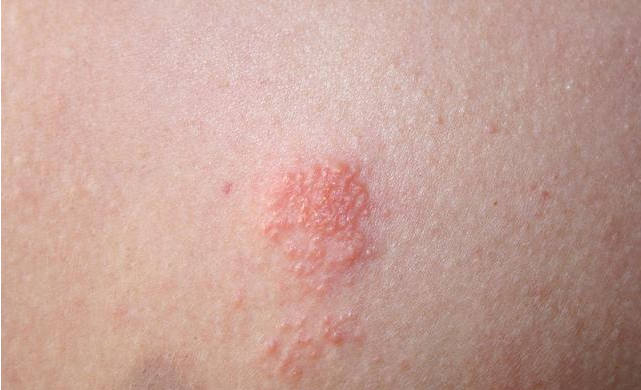 女性患生殖器皰疹的癥狀 女性患有生殖器皰疹有哪些危害 女性患生殖器皰疹的癥狀 女性患有生殖器皰疹有哪些危害