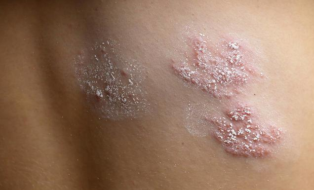 帶狀皰疹和生殖器皰疹一樣嗎 生殖器皰疹和帶狀皰疹有什么區別