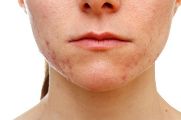 孕期孕婦長了很多痘是怎么回事 孕婦長了很多痘怎么辦