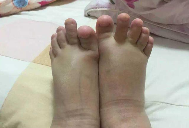 孕婦生理性水腫怎么緩解 孕期水腫什么時(shí)候恢復(fù)正常 孕婦生理性水腫怎么緩解 孕期水腫什么時(shí)候恢復(fù)正常