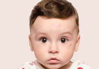 寶寶一到夏天就長(zhǎng)痱子是怎么回事 寶寶痱子怎么護(hù)理