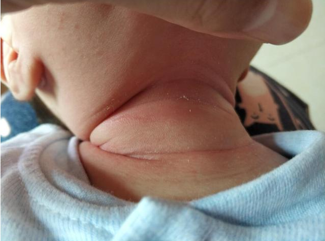 寶淹脖子發紅怎么護理 如何避免淹脖子復發 寶淹脖子發紅怎么護理 如何避免淹脖子復發